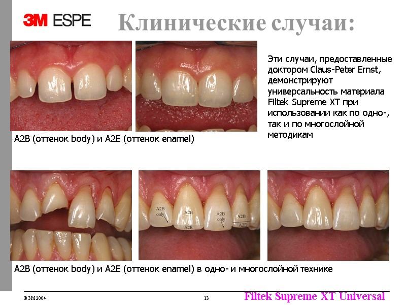 Эти случаи, предоставленные доктором Claus-Peter Ernst, демонстрируют универсальность материала Filtek Supreme XT при использовании Эти случаи, предоставленные доктором Claus-Peter Ernst, демонстрируют универсальность материала Filtek Supreme XT при использовании